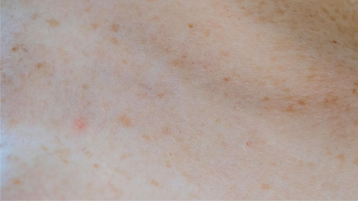 Exposição solar ao longo dos anos causa manchas brancas na pele dos idosos - Pexels