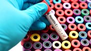 As hepatites são causadas por microorganismos que têm uma predileção específica por infectar as células do fígado - Adobe Stock