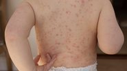 Recomendação é que todas as pessoas de 6 meses a 59 anos sejam vacinadas - Adobe Stock