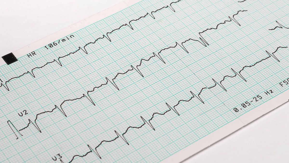 Alterações no batimento cardíaco podem estar relacionadas a arritmia ou problemas mais graves; entenda as causas e sintomas - AdobeStock
