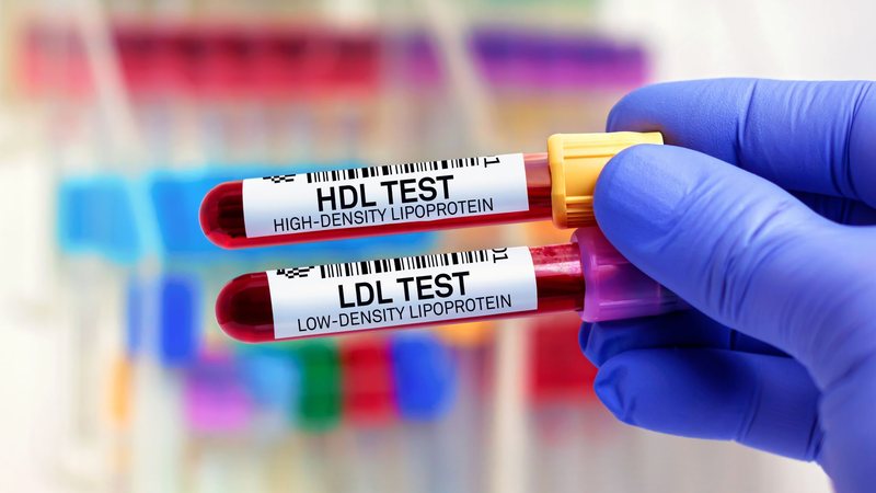 O acompanhamento das frações de colesterol no sangue é importante para prevenção de doenças como o infarto e AVC - Adobe Stock