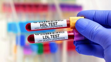 O acompanhamento das frações de colesterol no sangue é importante para prevenção de doenças como o infarto e AVC - Adobe Stock