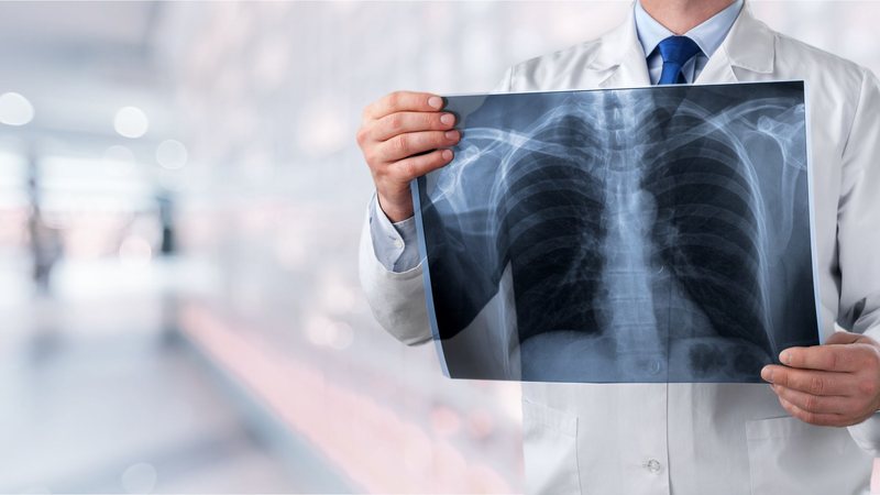 Hoje, o câncer de pulmão é a neoplasia mais diagnosticada e mais letal do mundo - Adobe Stock