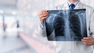 Hoje, o câncer de pulmão é a neoplasia mais diagnosticada e mais letal do mundo - Adobe Stock
