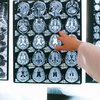 Esclerose múltipla é uma doença crônica e autoimune do sistema nervoso central - Pexels