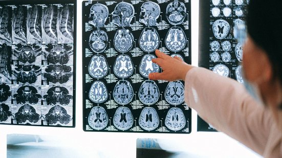 Esclerose múltipla é uma doença crônica e autoimune do sistema nervoso central - Pexels