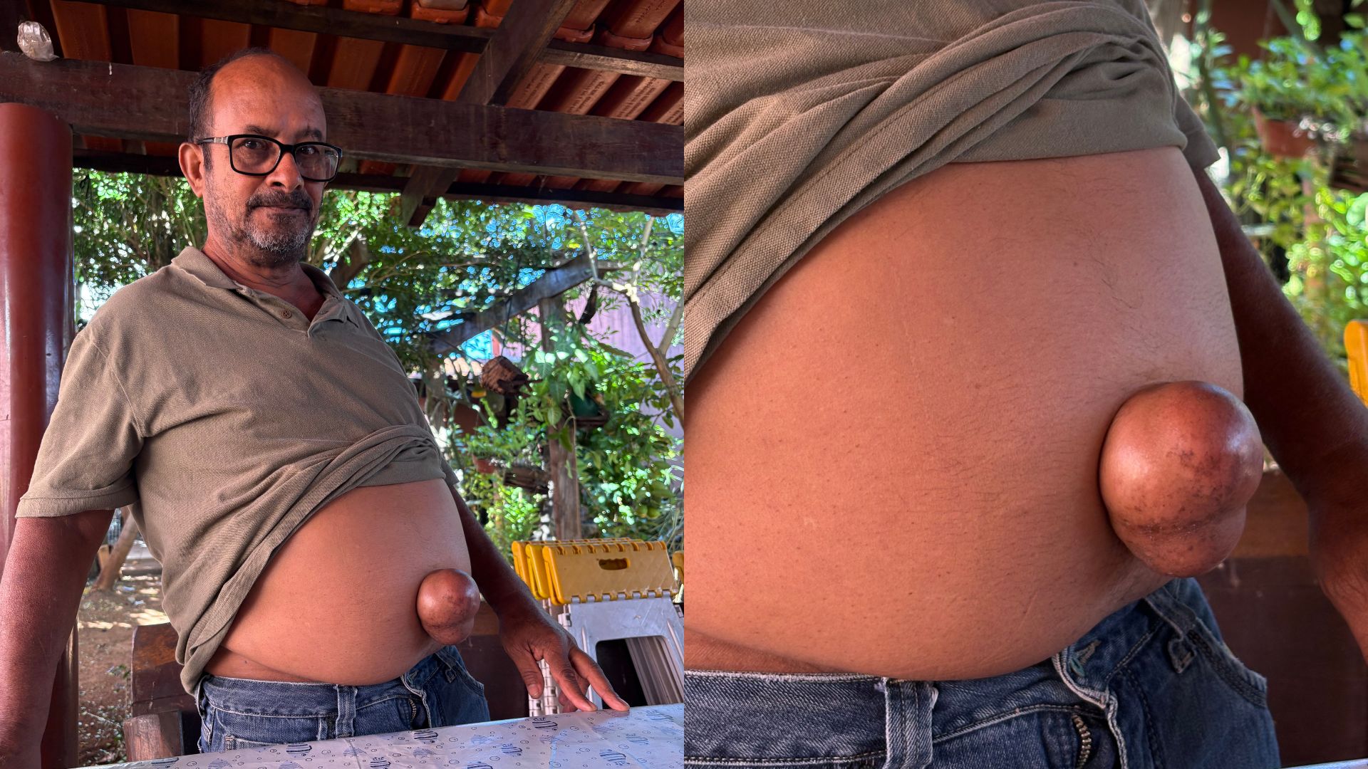 Vítima do Césio precisa de cirurgia para hérnia na barriga